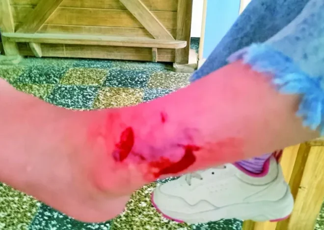 Preocupación en Próspero Palazzo: un perro mordió a una niña en plena plaza