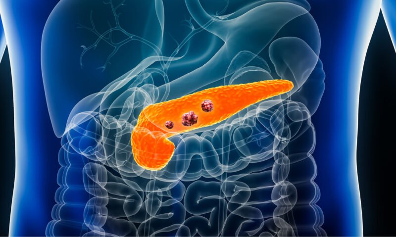 Un nuevo fármaco podría cambiar el pronóstico del cáncer de páncreas: duplicó la supervivencia de pacientes avanzados Un nuevo fármaco podría cambiar el pronóstico del cáncer de páncreas: duplicó la supervivencia de pacientes avanzados