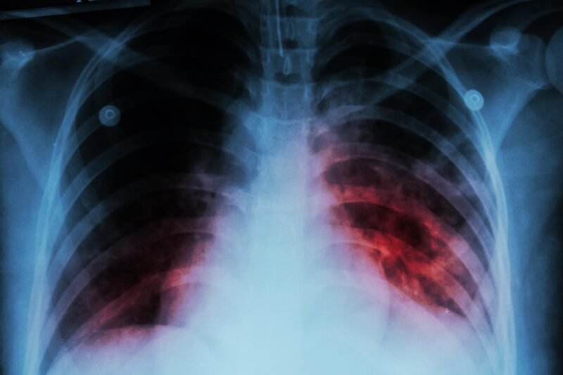 Alerta sanitaria en Tucumán: los casos de tuberculosis crecieron un 25% y preocupa el avance de la enfermedad